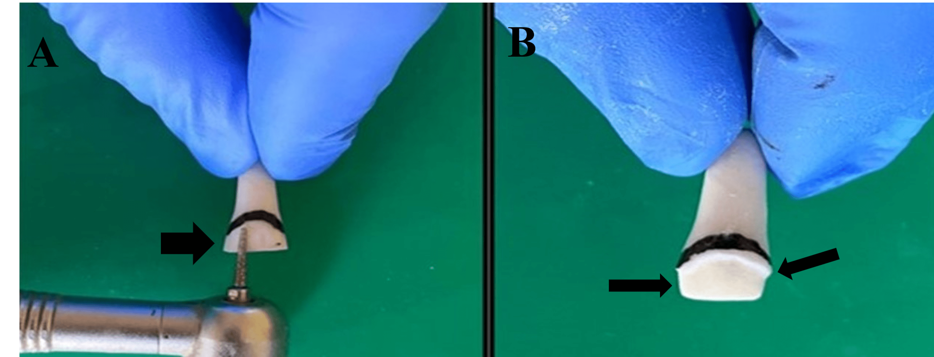 Cureus Rehabilitation of Traumatised Maxillary Anterior Teeth in