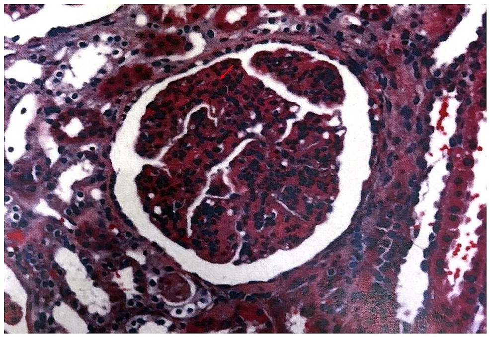 Role of Steroids in Poststreptococcal Glomerulonephritis Without