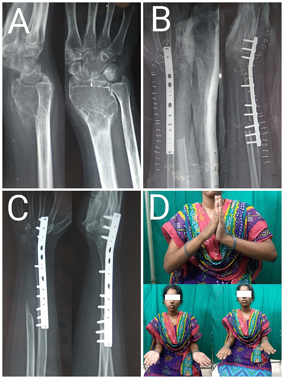 Case-images-of-a-20-year-old-female-patient-with-Campanacci-grade-III-giant-cell-tumor-of-right-distal-radius