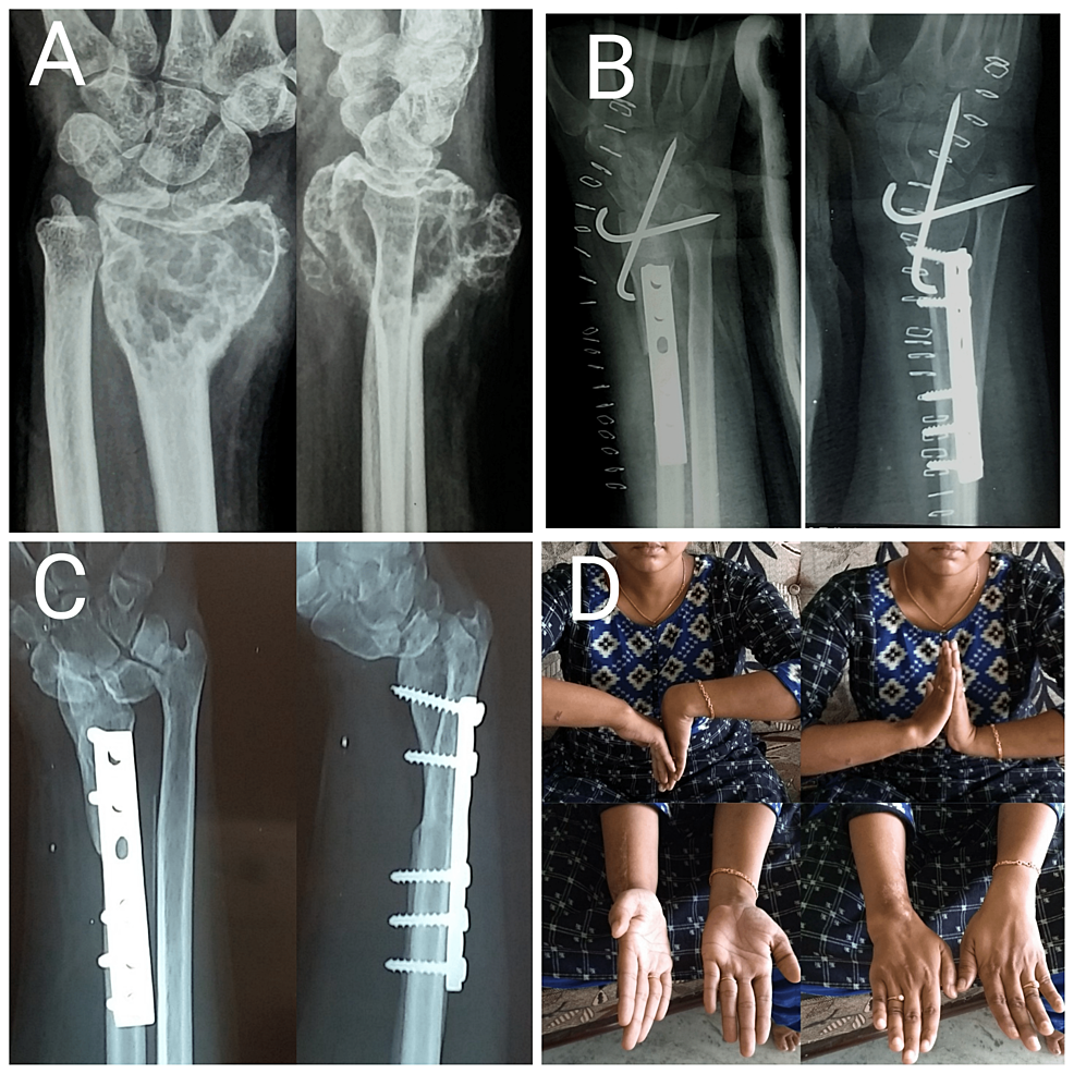 Cureus | Campanacci Grade III Giant Cell Tumors Of Distal End Radius ...