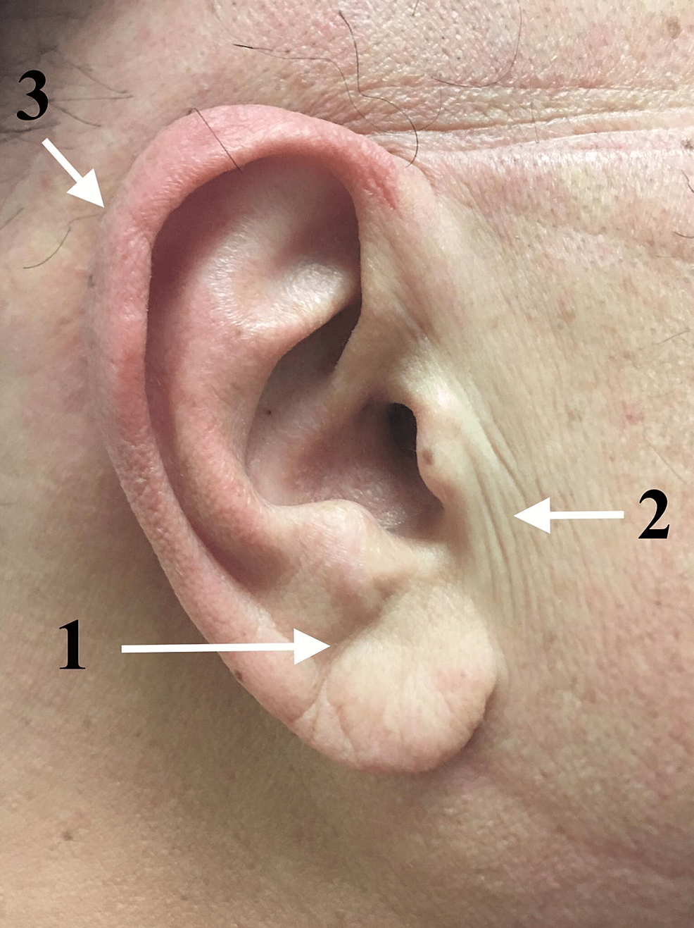 Cureus Unified Anatomical Explanation of Diagonal Earlobe Creases