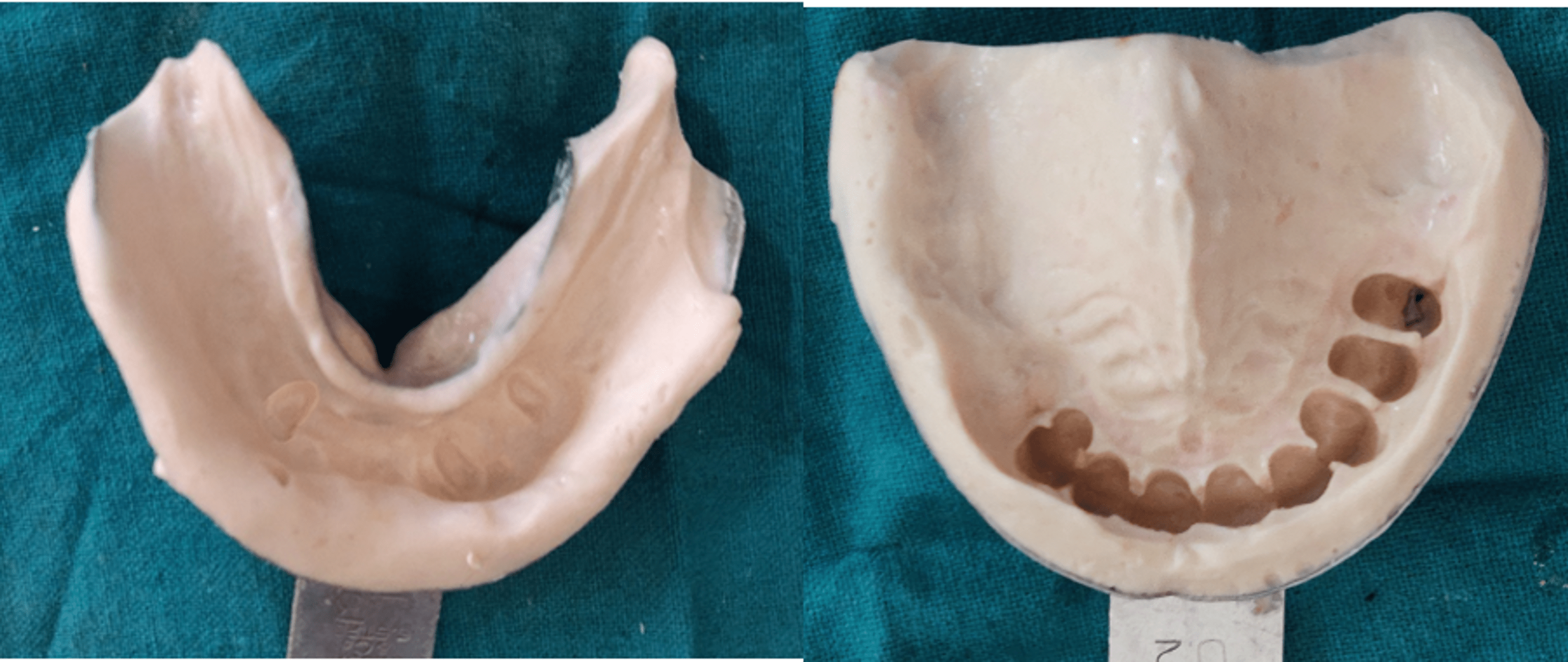Cureus Prosthetic Rehabilitation of a Partially Dentate Patient With a Maxillary Cast Partial
