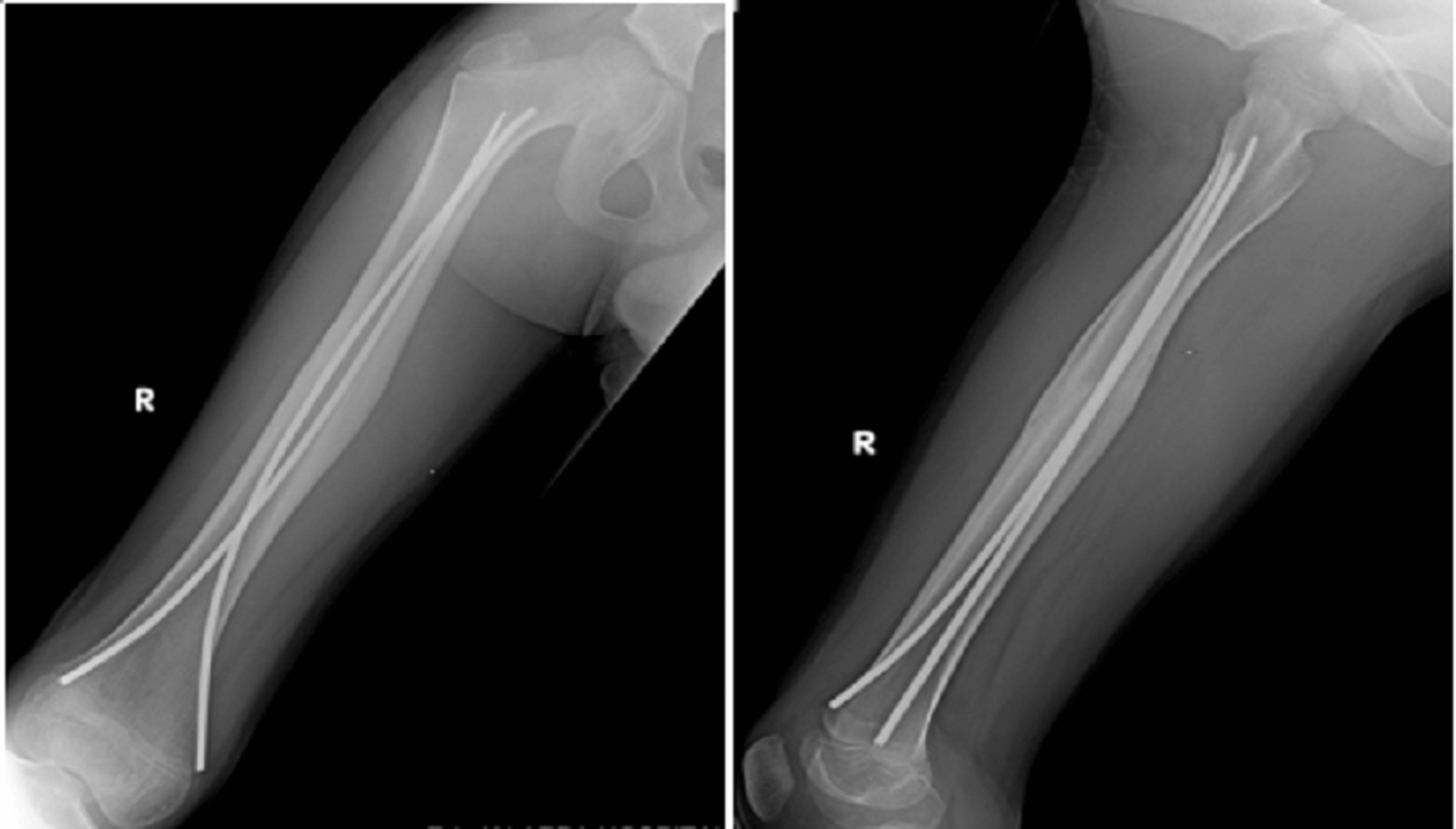 Cureus Treatment of Diaphyseal Fractures of the Femur in Paediatric