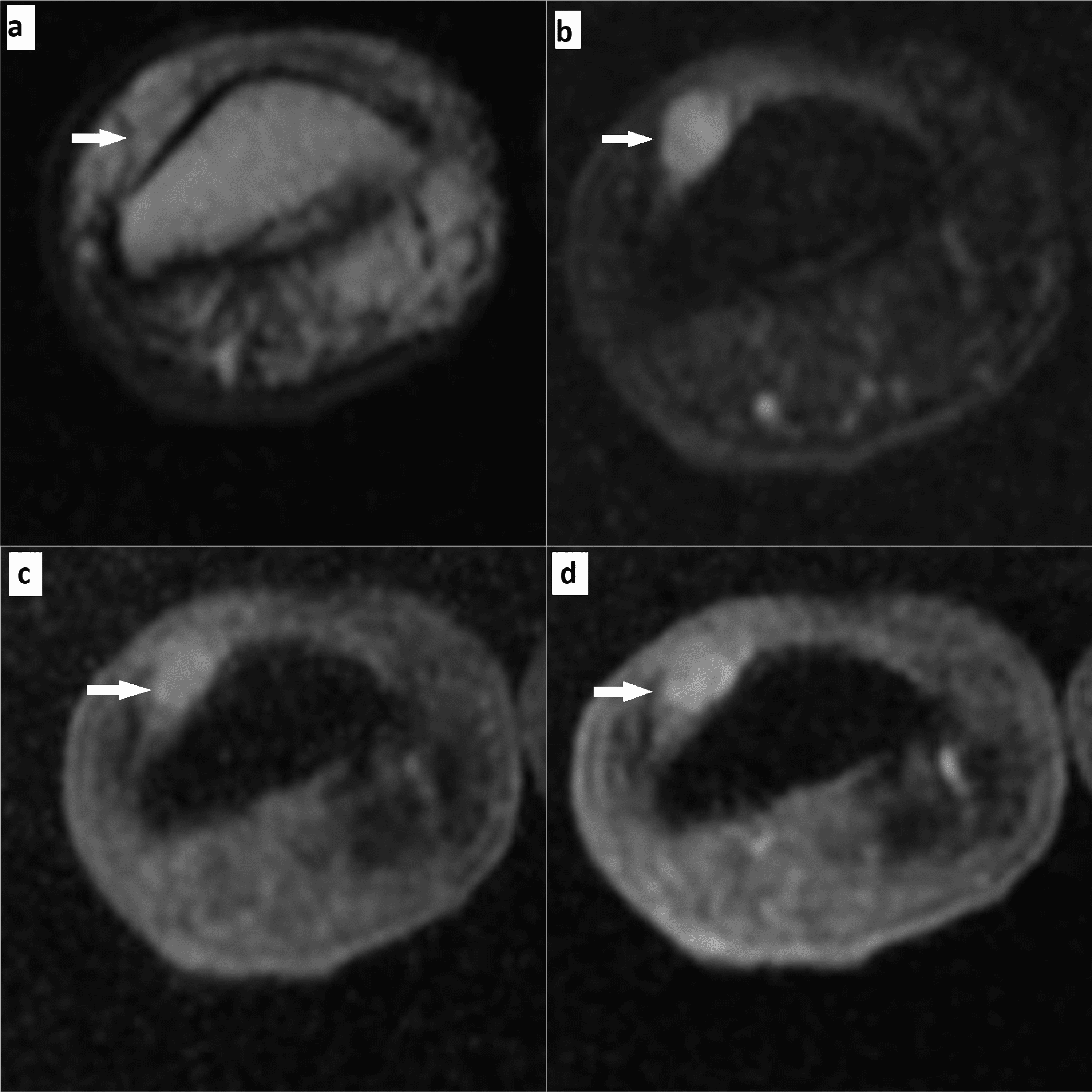Cureus Hand and Foot Glomus Tumors Significance of MRI Diagnosis