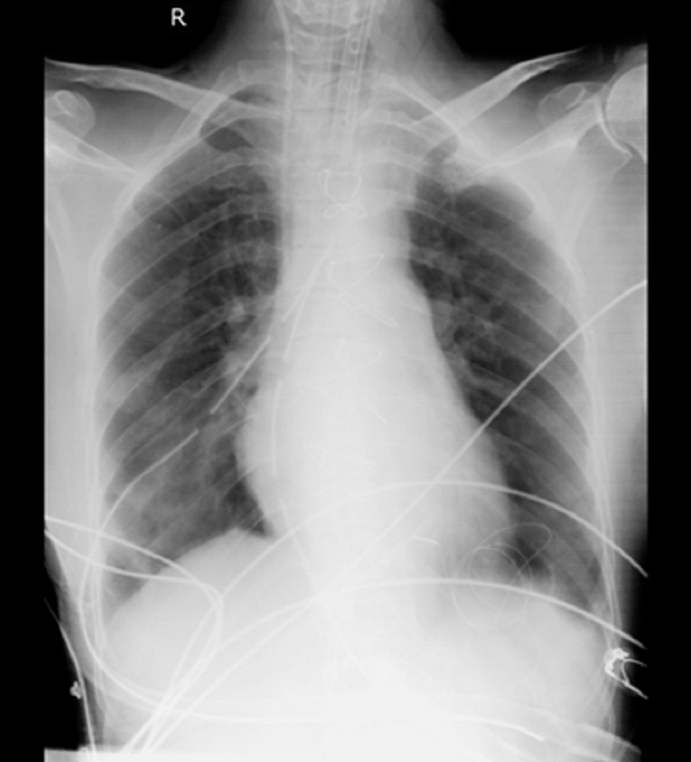 Postoperative-chest-x-ray-PA-view