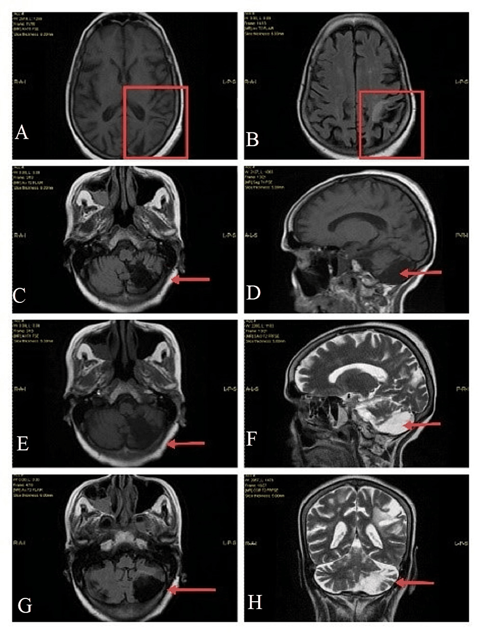 Postoperative-MRI-findings