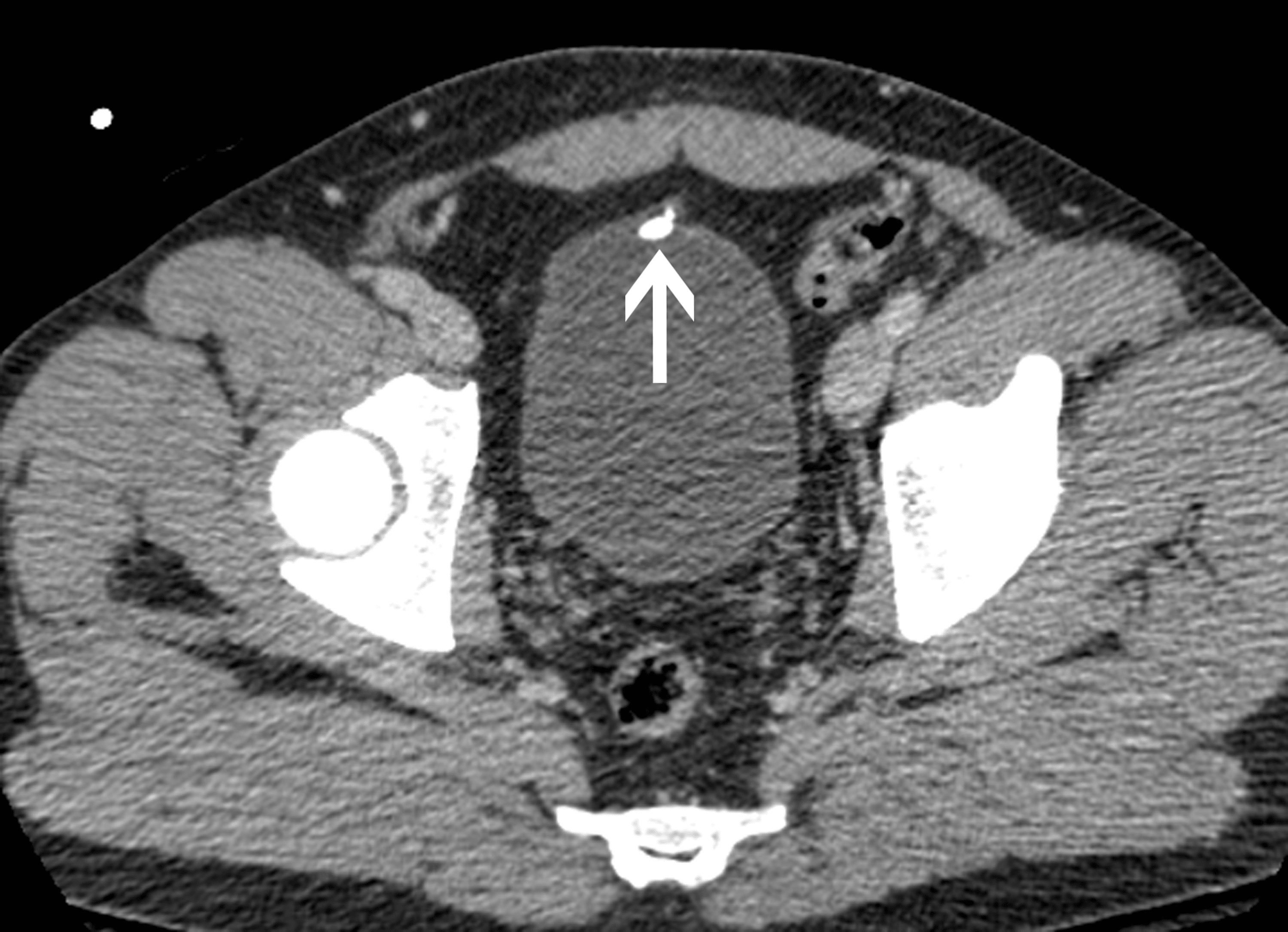Cureus Urachal Remnant Calcification A Rare Cause of Calcification