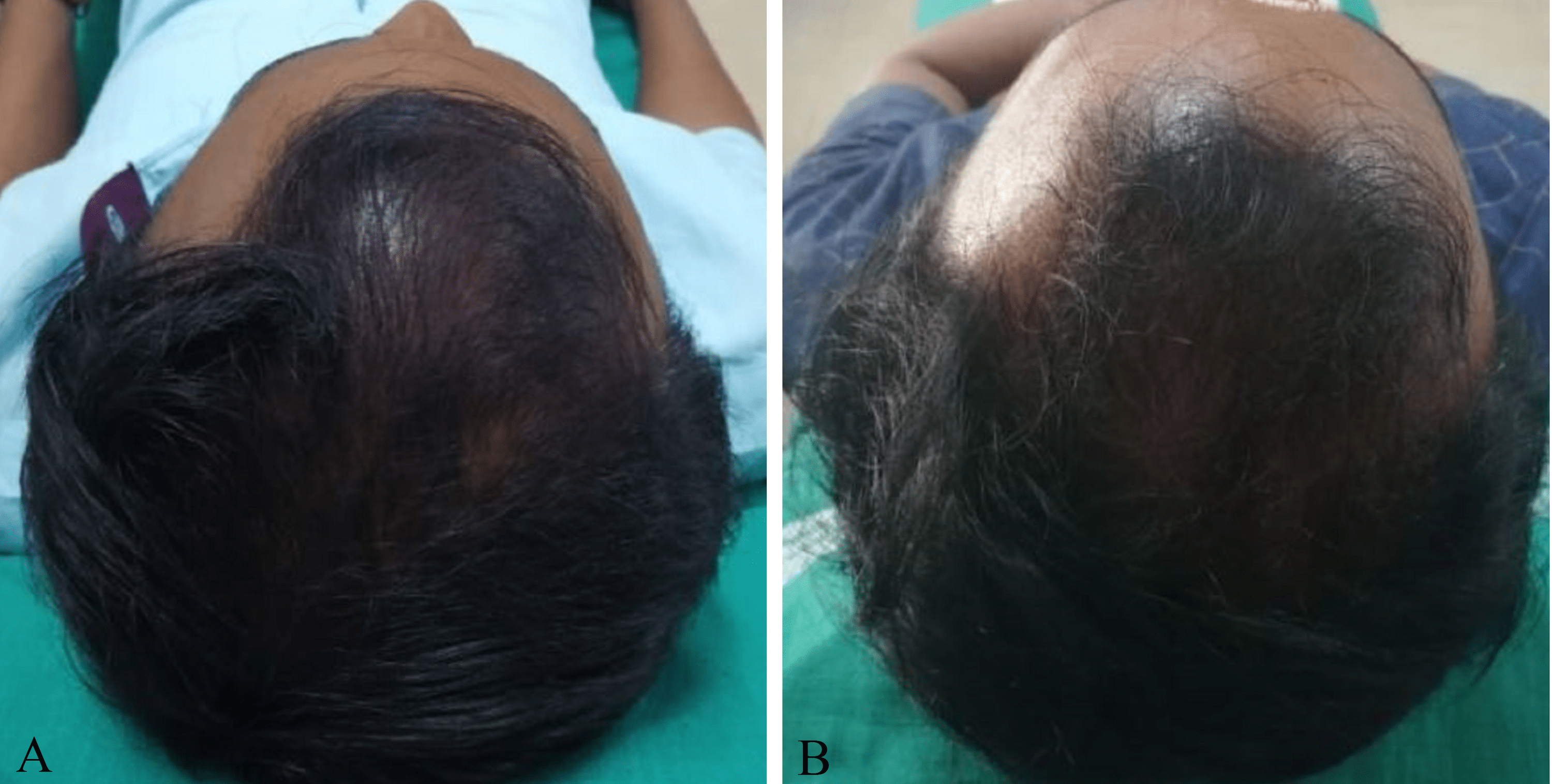 Male Androgenetic Alopecia - Endotext - NCBI Bookshelf