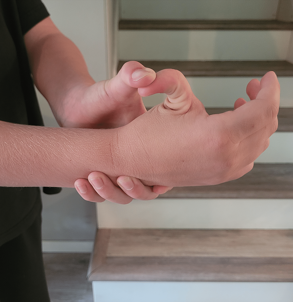 Cureus Joint Hypermobility as a Potential Indicator of Marfan