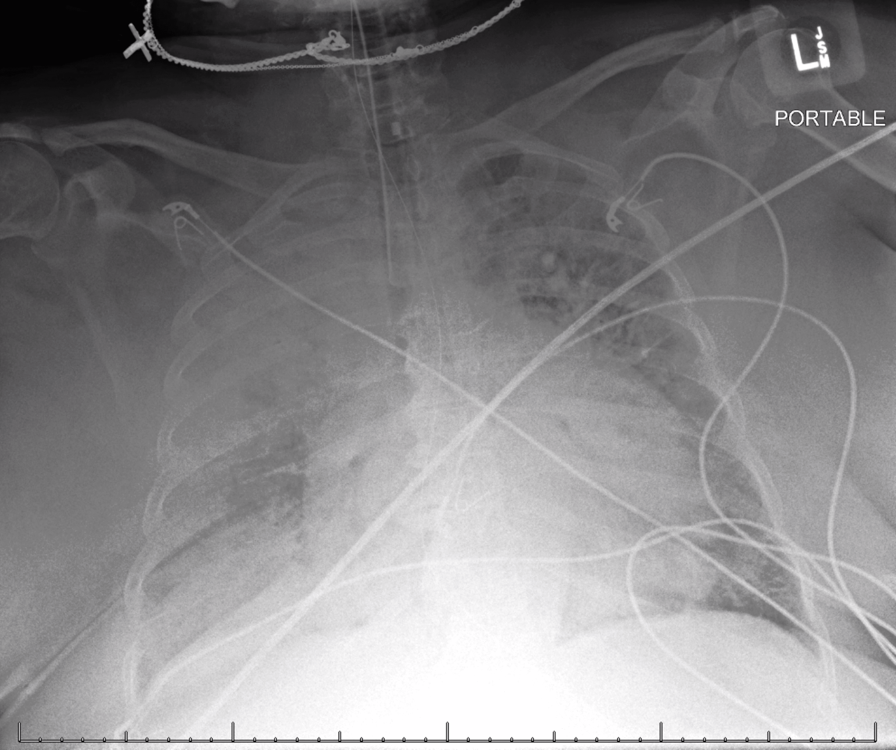 Cureus | Acute Mitral Valve Regurgitation Presenting With Right Upper ...