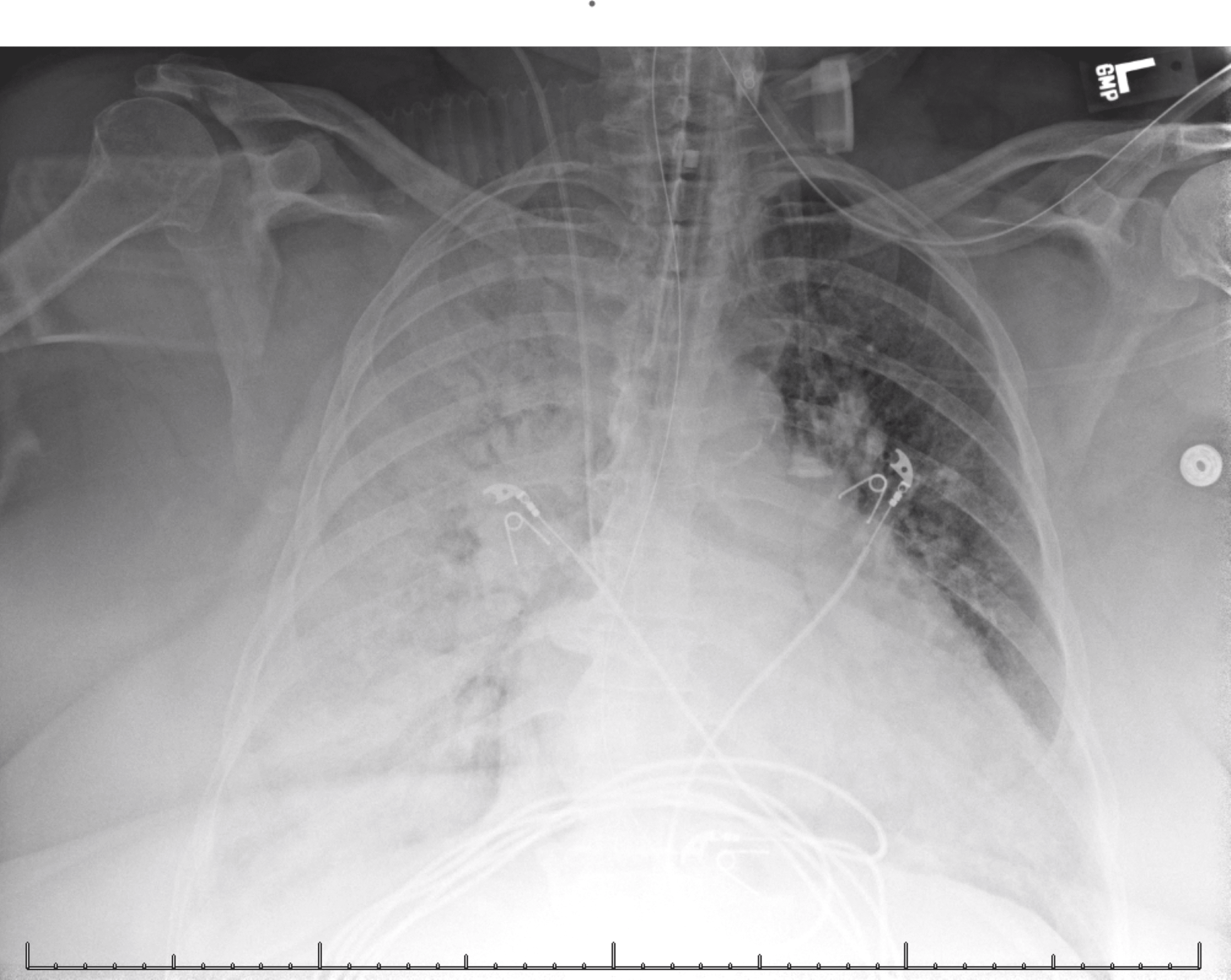 Cureus | Acute Mitral Valve Regurgitation Presenting With Right Upper ...