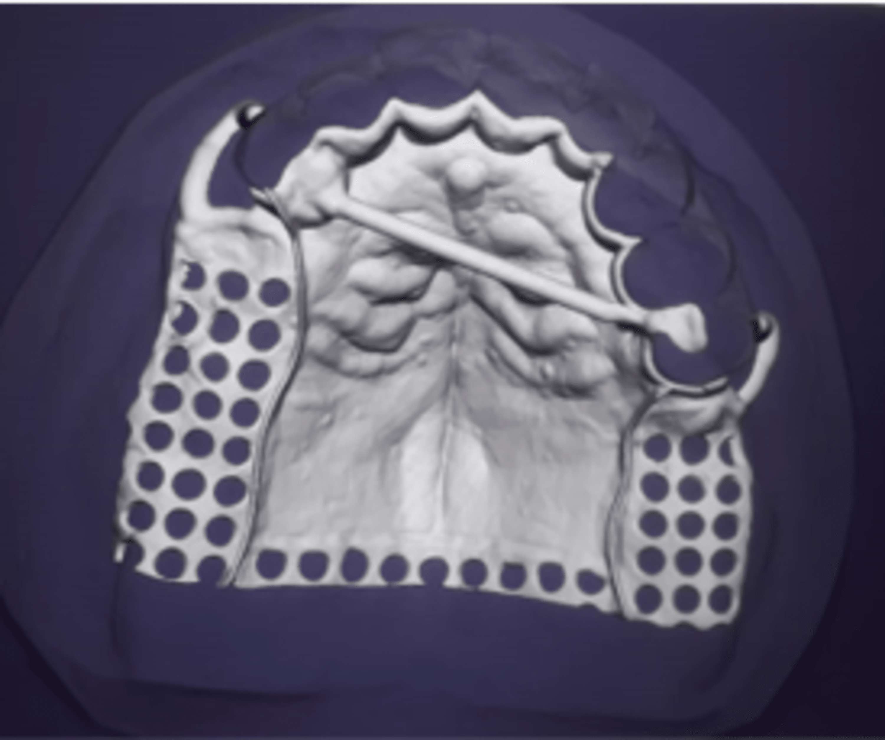 Cureus Prosthetic Rehabilitation of a Partially Dentate Patient With