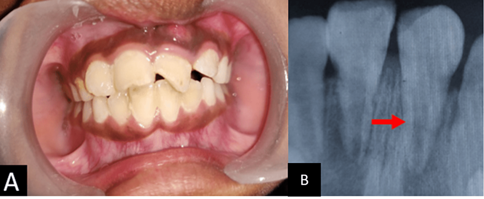 Control of Horizontal Root Fracture in Anterior Enamel: A Case File