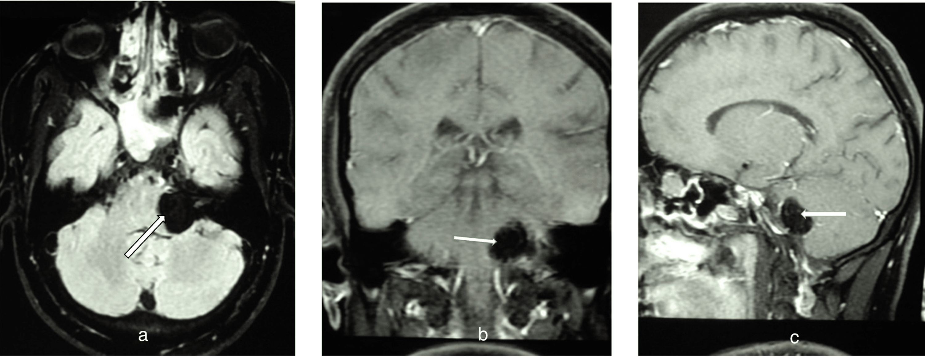 Cureus | Surgical Management of Cerebellopontine Angle (CPA) Lipoma ...