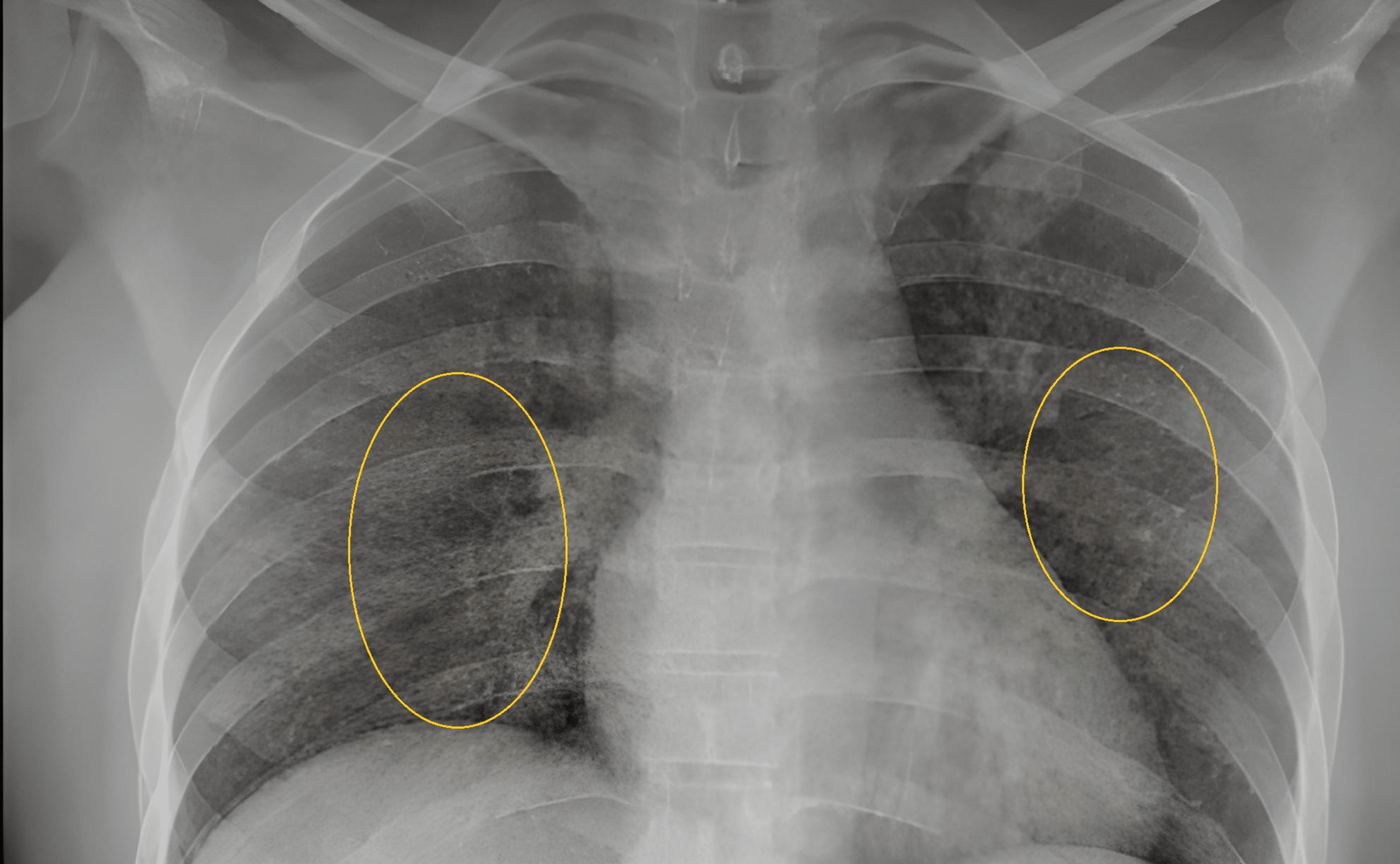 Cureus Unilateral Choroidal Granuloma and a Pupillary Abnormality in