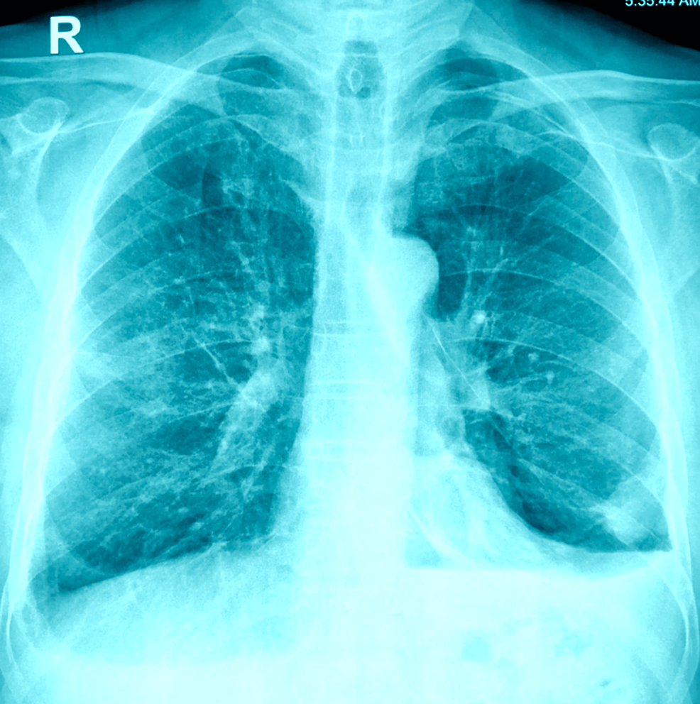 Cureus | Chemotherapy Associated Bilateral Secondary Spontaneous ...