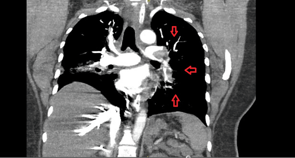 Cureus of CatheterDelivered Thrombolytic Therapy and