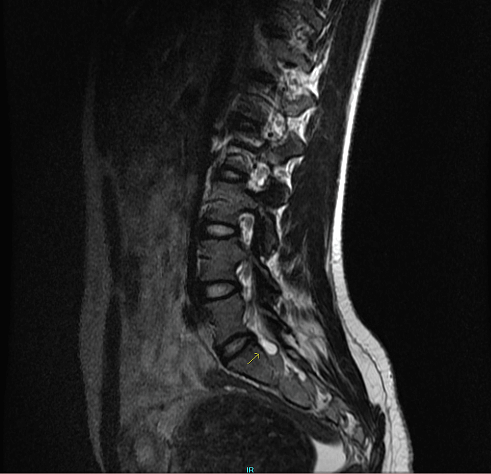 cureus-sciatica-in-early-pregnancy-with-coexisting-uterine-leiomyoma