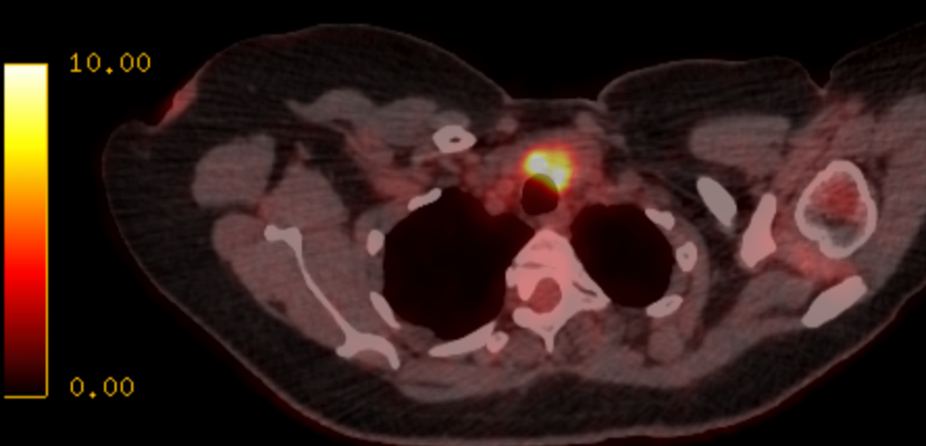 Cureus An Unusual Presentation Of Subacute Thyroiditis As Pyrexia Of