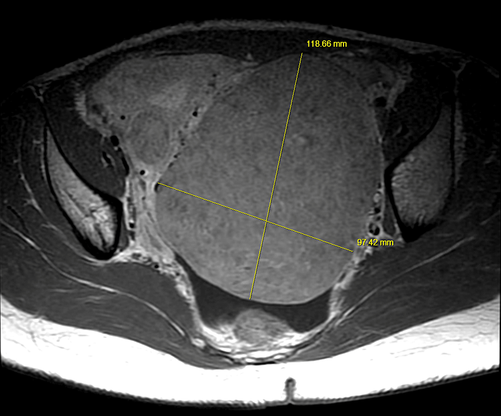 Axial-pelvic-MRI-showing-a-large-uterine-fibroid-measuring-approximately-120-x-100-mm.-Structures-(sciatic-nerve)-in-between-the-fibroid-and-piriformis-muscle-on-the-left-side-appear-compressed-compared-to-the-right-side.