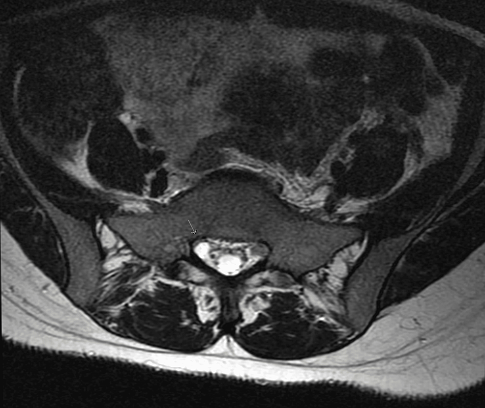 Axial-lumbar-MRI-showing-a-tiny-Tarlov-cyst-on-the-right-side-indicated-by-an-arrow.