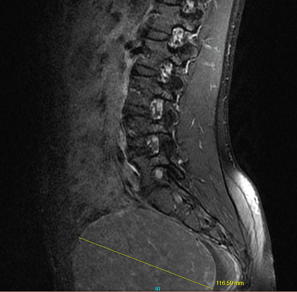 Sagittal-lumbar-MRI-showing-a-large-uterine-fibroid-in-the-pelvic-region-measuring-approximately-120-mm.