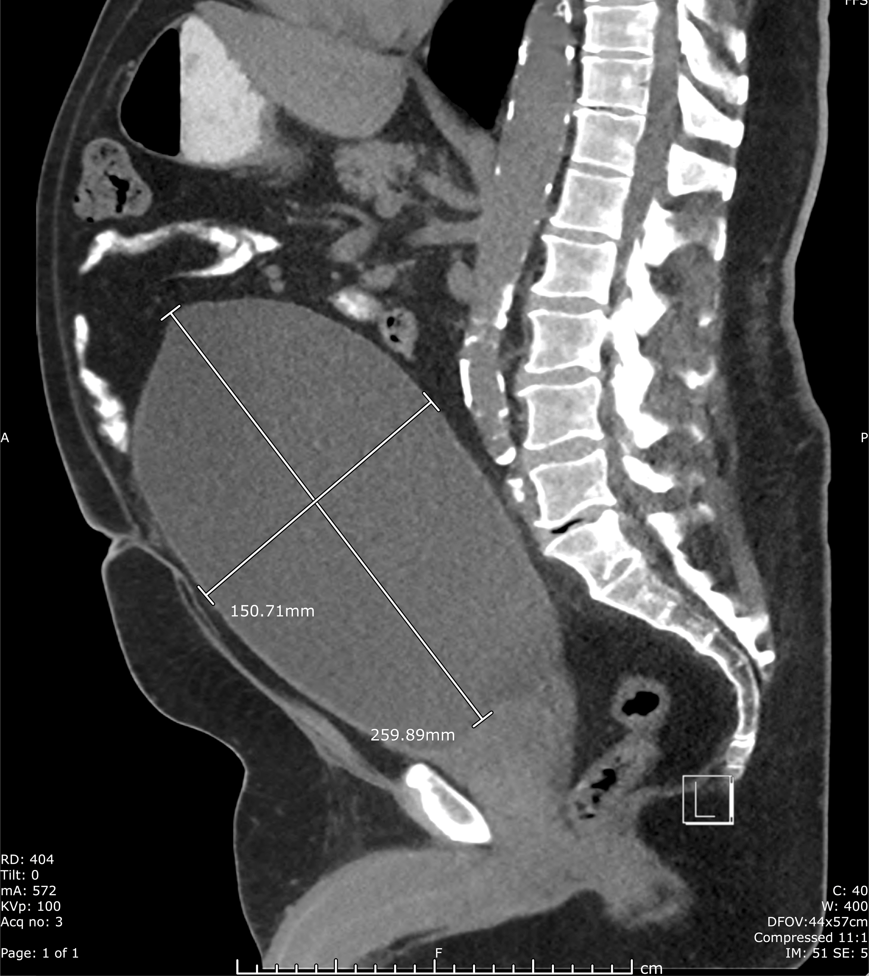 Cureus Severe Urinary Retention Resulting in Extreme Postobstructive