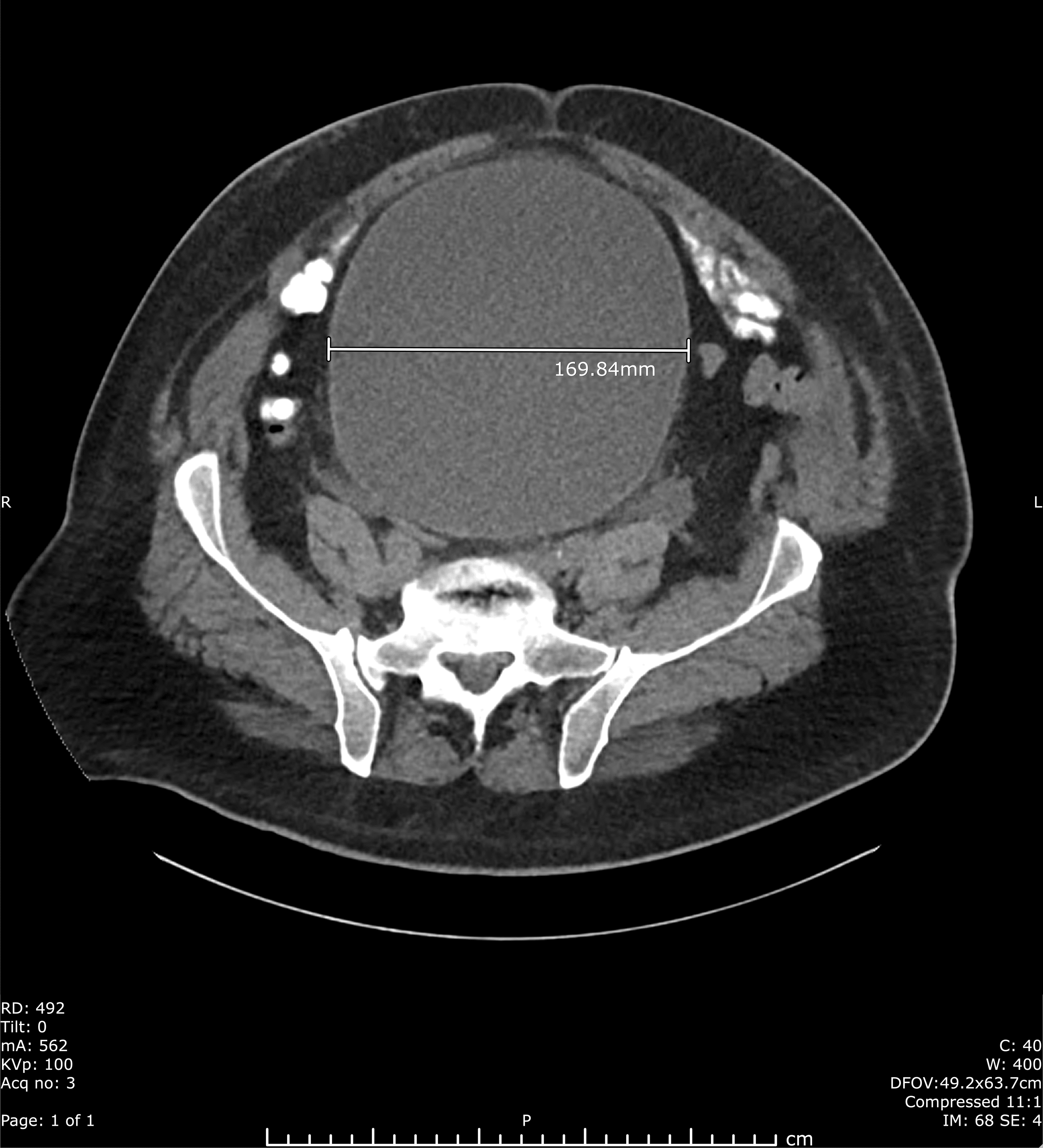 Cureus Severe Urinary Retention Resulting In Extreme Post Obstructive Diuresis And 9625