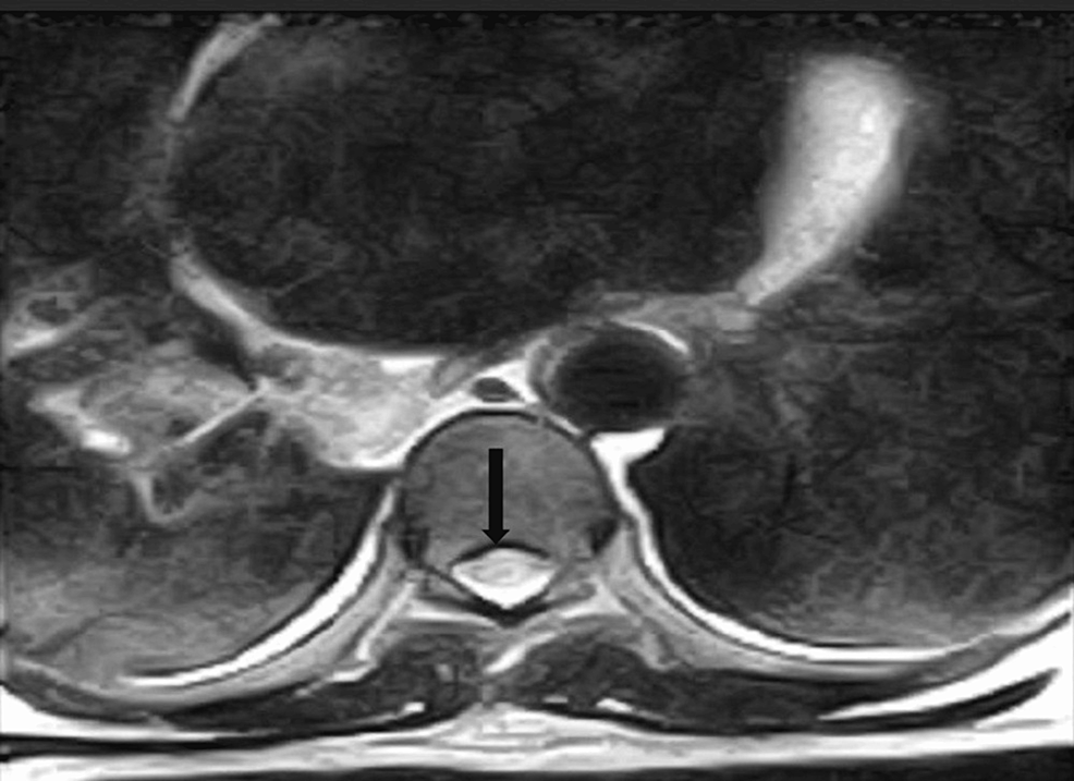 Pdf Creation Of An Intramedullary Cavity By Hemorrhagic Necrosis