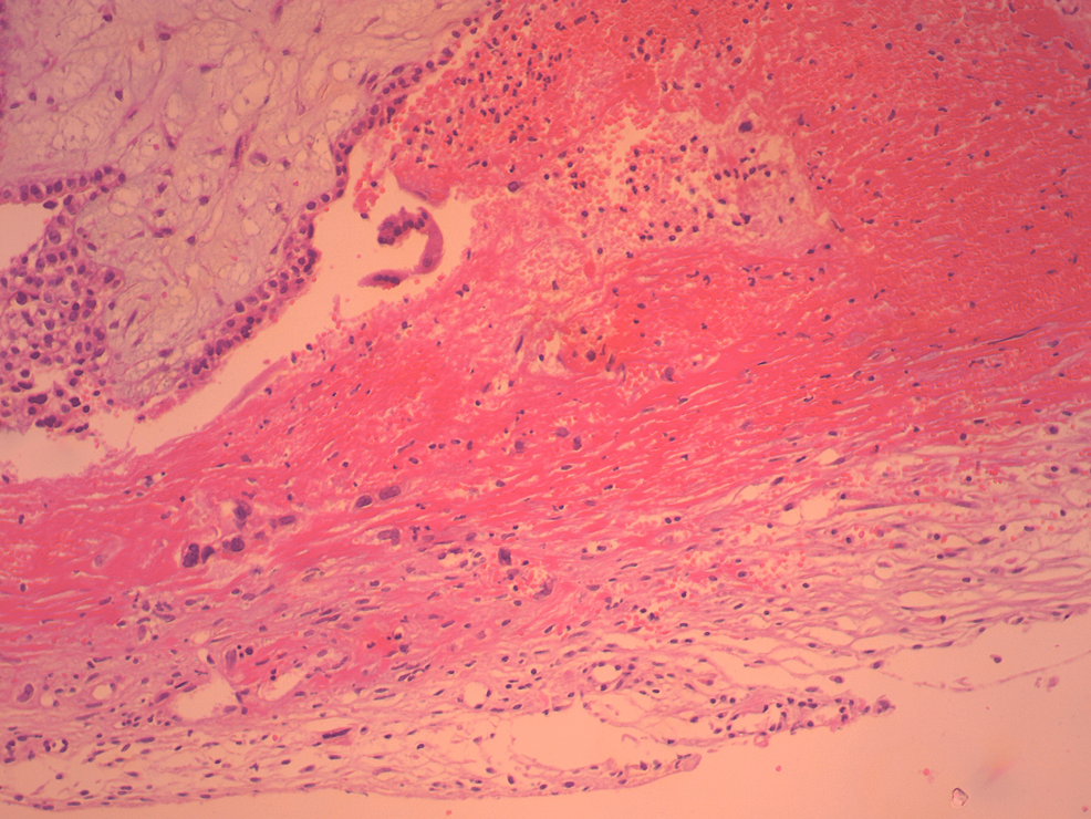Histological-image-of-a-ruptured-ectopic-ovarian-pregnancy-(our-case)-