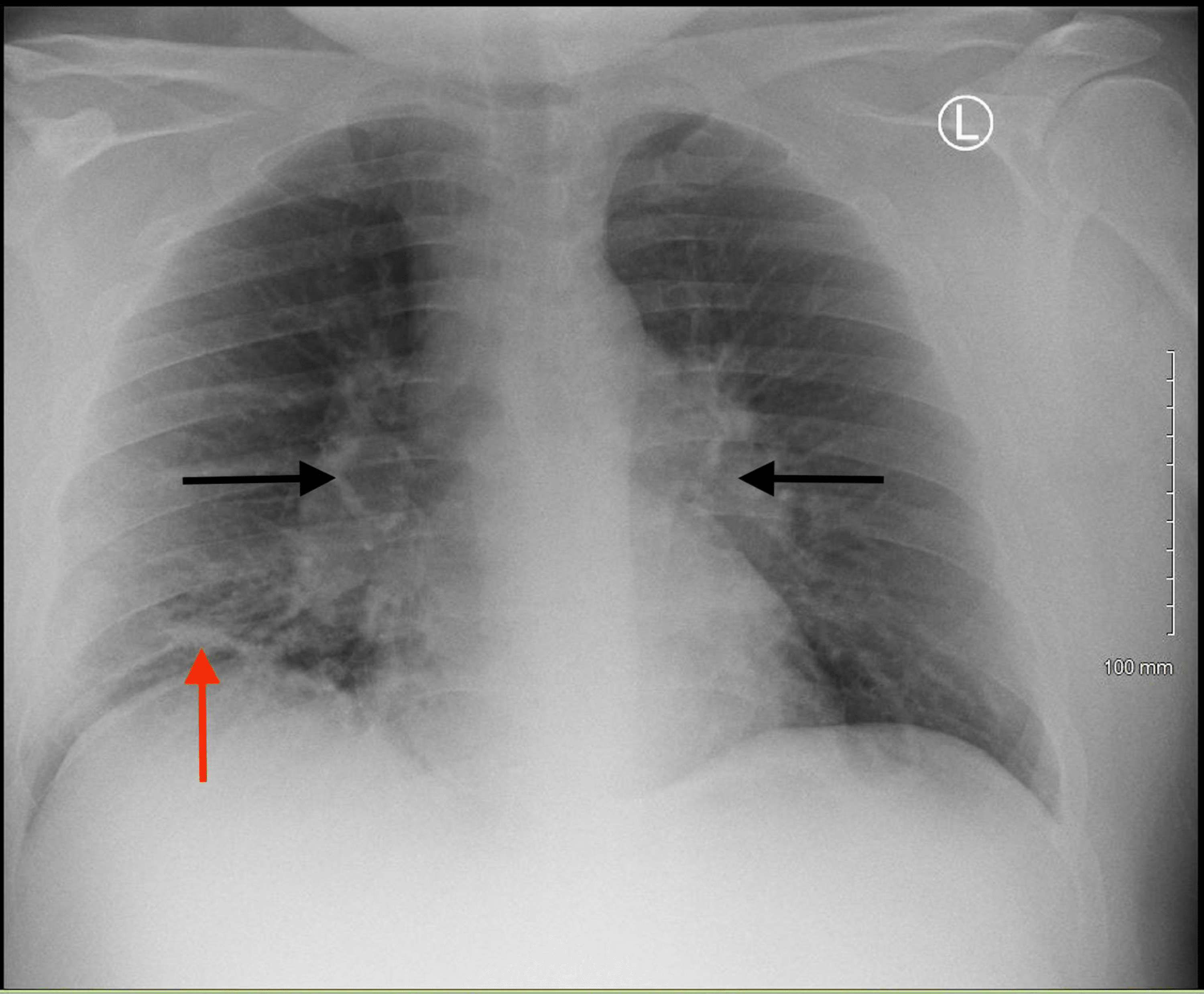 Cureus | A Case of Sarcoidosis Masquerading as Right Middle Lobe ...