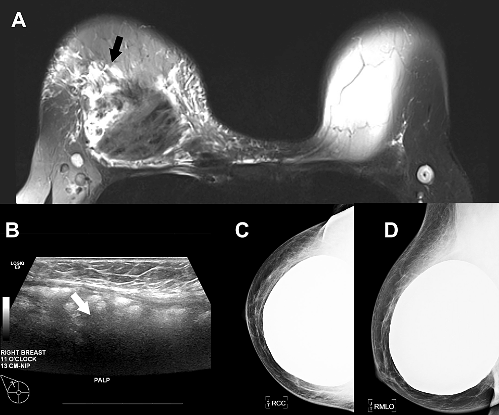 (A)-Magnetic-resonance-imaging-shows-prepectoral-silicone-implant-with-intracapsular-rupture,-with-free-silicone-and-associated-non-mass-enhancement-likely-representing-granulomatous-reaction.-(B)-Ultrasound-showing-snowstorm-appearance-consistent-with-free-silicone.-(C)-Craniocaudal-and-(D)-mediolateral-oblique-mammogram-views-did-not-show-free-silicone-(likely-obscured-by-the-overlying-implant).