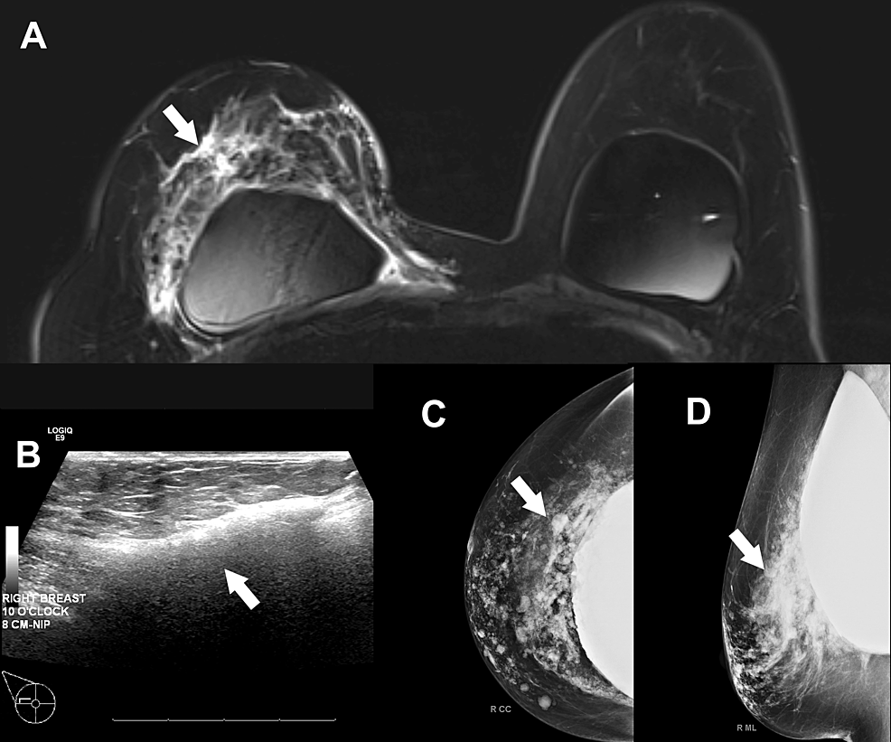 (A)-Right-breast-magnetic-resonance-imaging-showing-extensive-extracapsular-non-mass-enhancement.-(B)-Ultrasound-showed-multiple-areas-of-snowstorm-type-dispersion-consistent-with-free-silicone.-(C)-Craniocaudal-and-(D)-mediolateral-oblique-mammogram-images-showing-numerous-areas-consistent-with-silicone-granulomas.