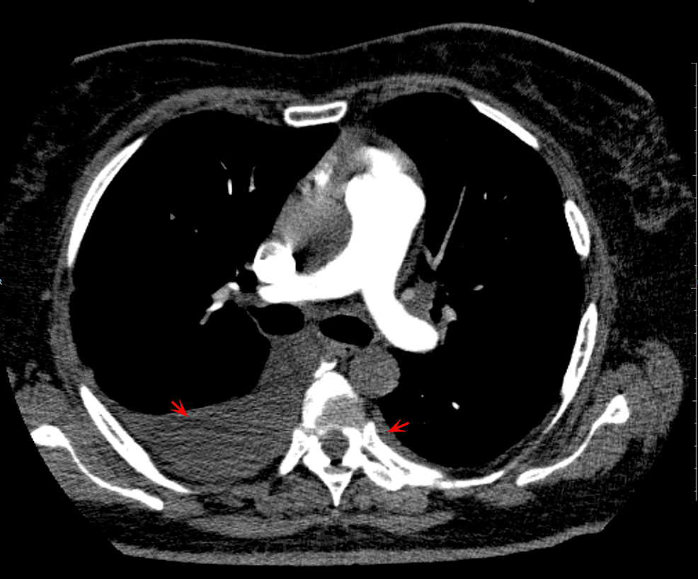 COVID 19 Induced Myocarditis And MRNA Vaccine Related Pericarditis A   Article River C9386530139311ed9c679d354d807563 Angio TC Legendas 