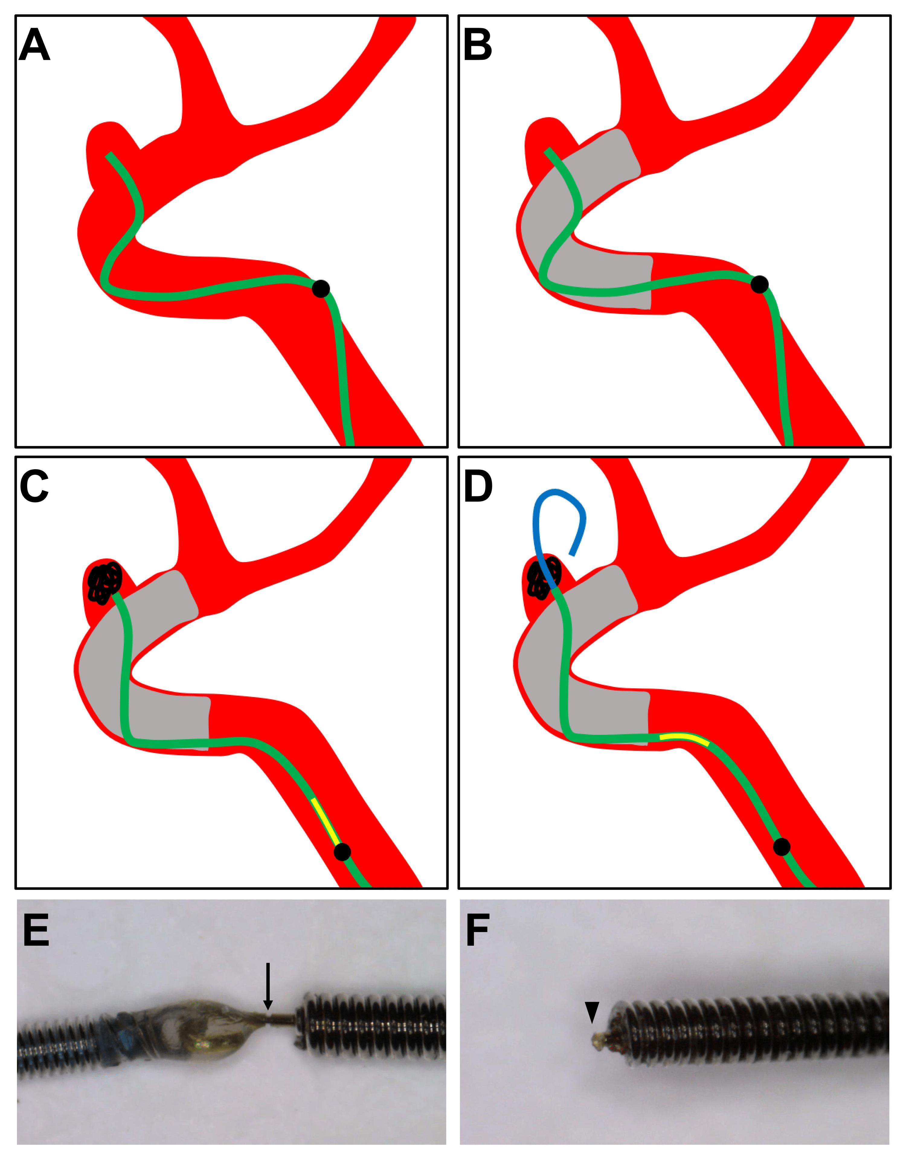 Cureus Aneurysm Perforation Due to Advancement of the Coil Delivery