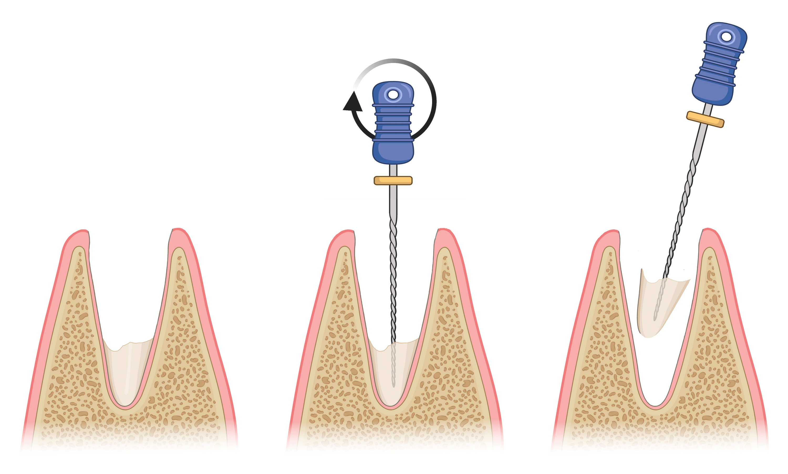 Cureus A Minimally Invasive Technique for the Retrieval of Fractured