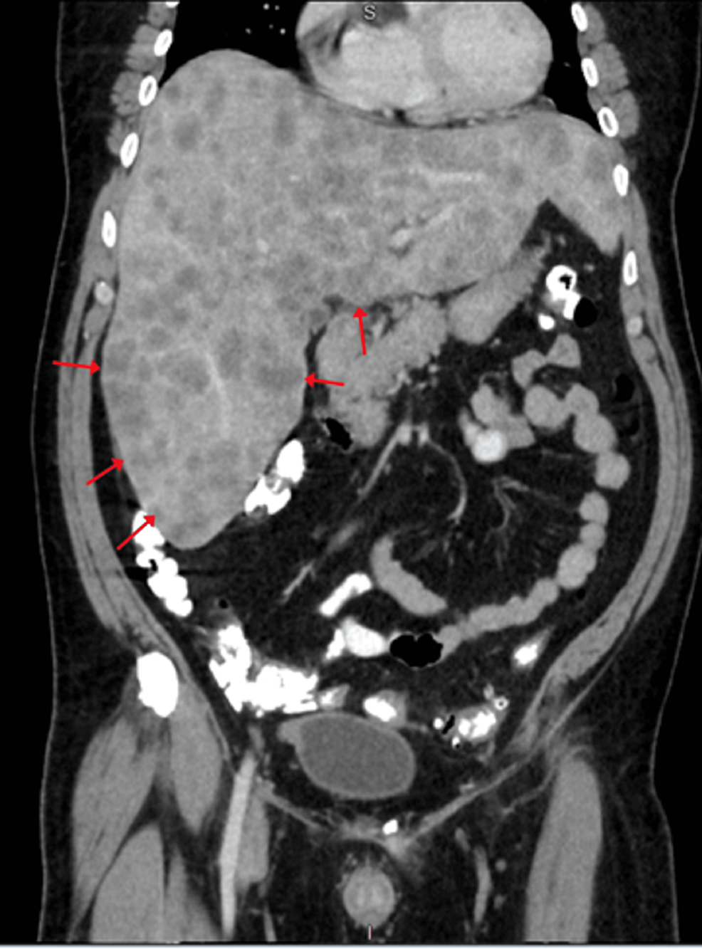 Cureus | Neuroendocrine Carcinoma of the Esophagus With Liver ...