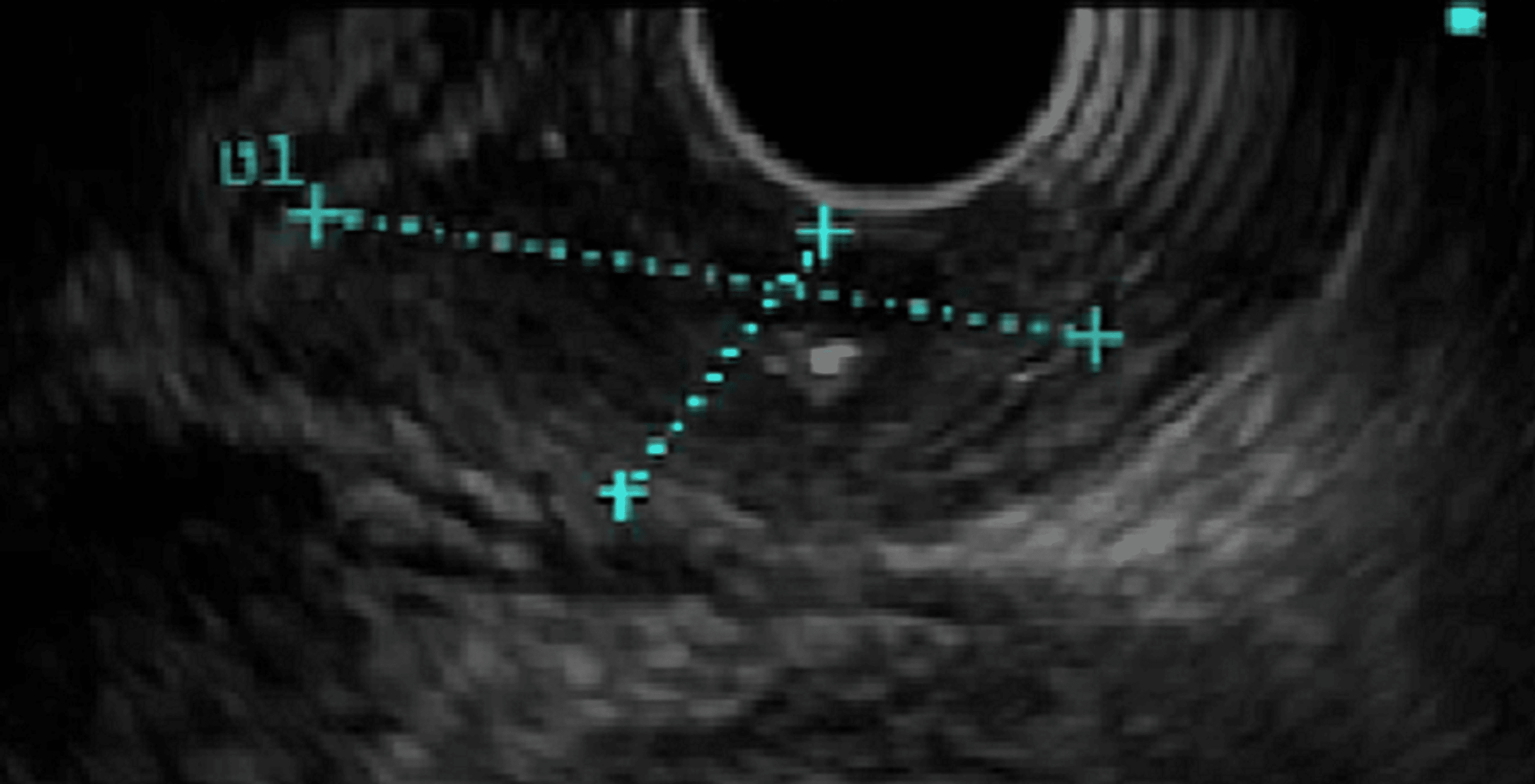 Neuroendocrine Carcinoma of the Esophagus With Liver Metastasis A Case