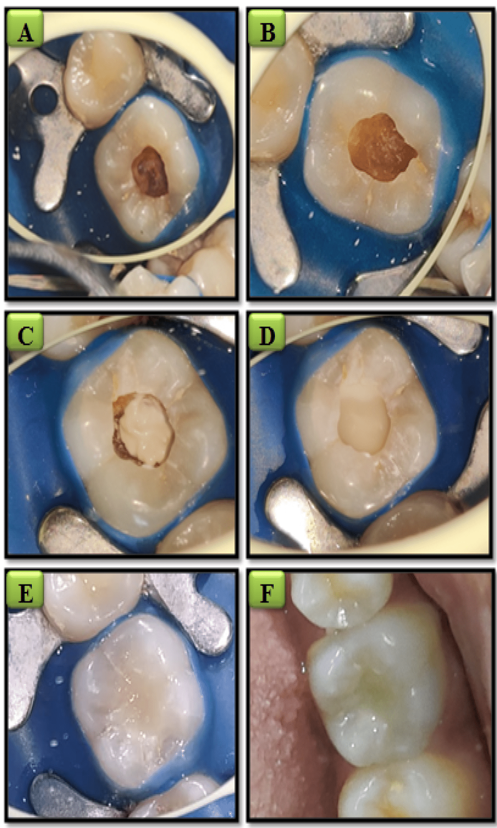 Comparative Evaluation of the Efficacy of LightCured Calcium Hydroxide