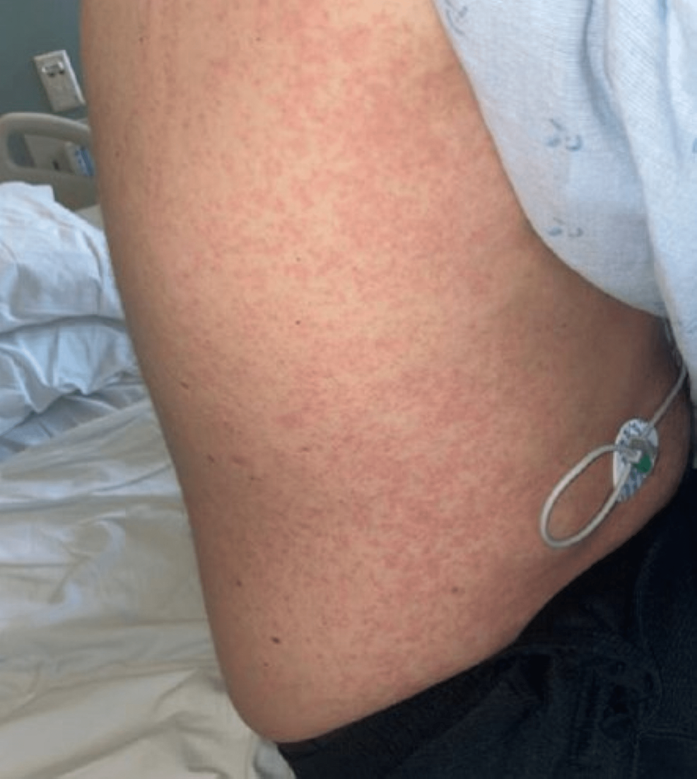 Hepatitis A Skin