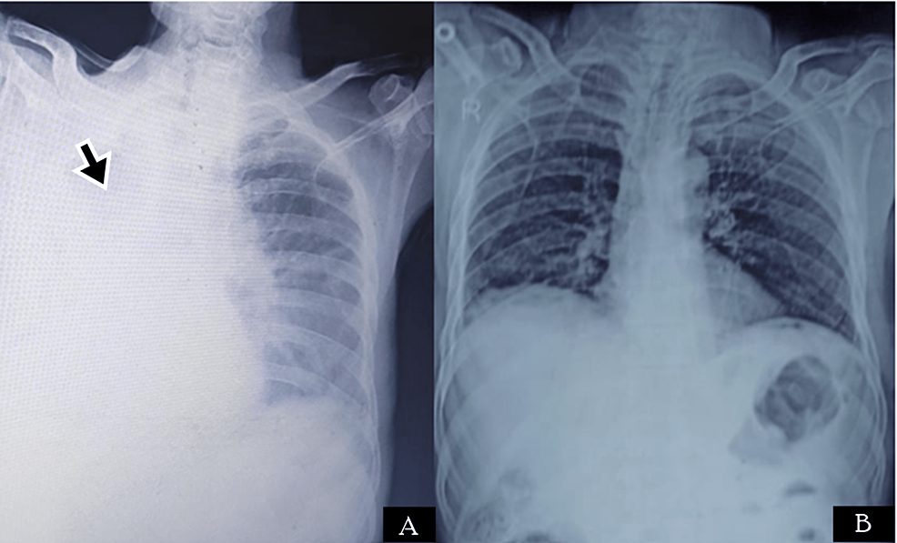 Radiological-images-of-Case-2.-(A)-CXR-showing-right-lung-homogenous-opacity-(black-arrow)-suggestive-of-resorption-collapse-due-to-mucus-plug;-(B)-CXR-after-the-removal-of-the-mucous-plug