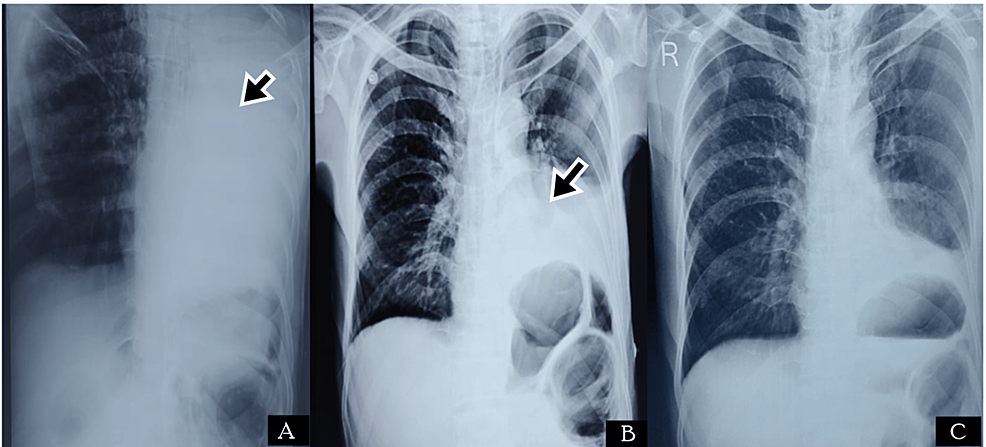 Radiological-images-of-Case-3.-(A)-CXR-showing-complete-homogenous-opacification-of-the-left-lung-(black-arrow);-(B)-CXR-after-four-days-of-treatment-showing-left-lower-zone-homogenous-opacity-(black-arrow)-with-left-CP-angle-obliteration,-suggestive-of-left-lung-basal-lobe-atelectasis-with-pleural-effusion;-(C)-CXR-after-two-weeks-of-recovery