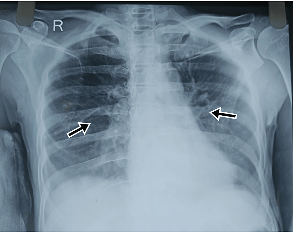 CXR-revealed-haziness-on-both-sides-of-the-chest-suggestive-of-bilateral-lower-zone-pneumonitis-(black-arrows)