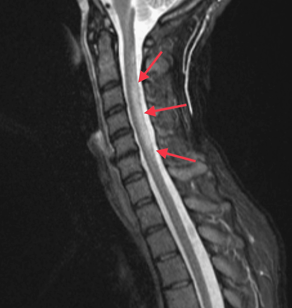 Cureus Nitrous OxideInduced Subacute Combined Degeneration in a 38