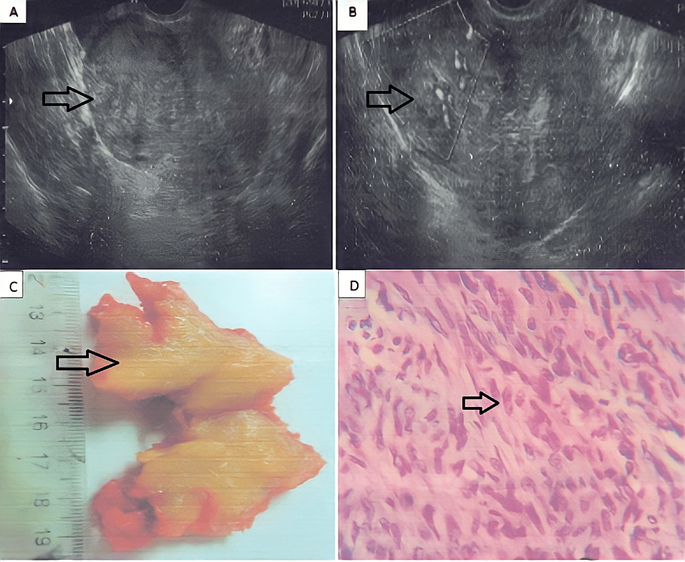 Highly Cellular Leiomyoma Mixed With A Focus Of Adenomyosis Cureus