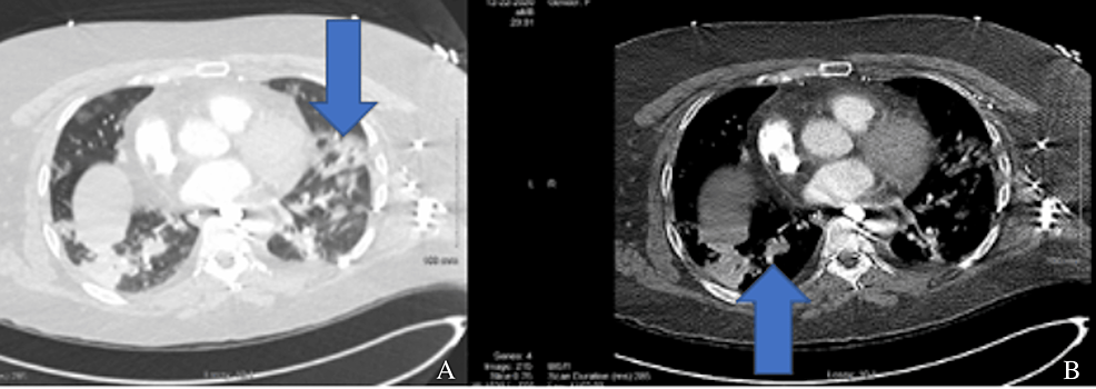(A)-and-(B)-are-thoracic-cavity-CT-scans-that-show-bilateral-extensive-multilobar-airspace-disease,-which-is-consistent-with-COVID-19-pneumonia.-