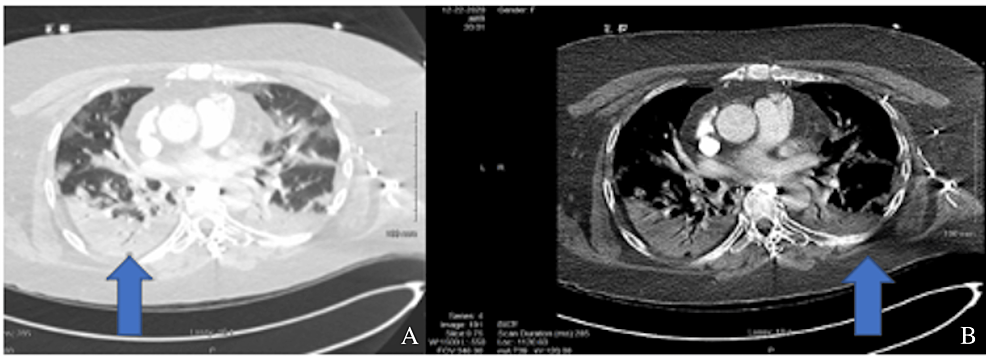 (A)-and-(B)-are-thoracic-cavity-CT-scans-that-show-bilateral-extensive-multilobar-airspace-disease,-which-is-consistent-with-COVID-19-pneumonia.-