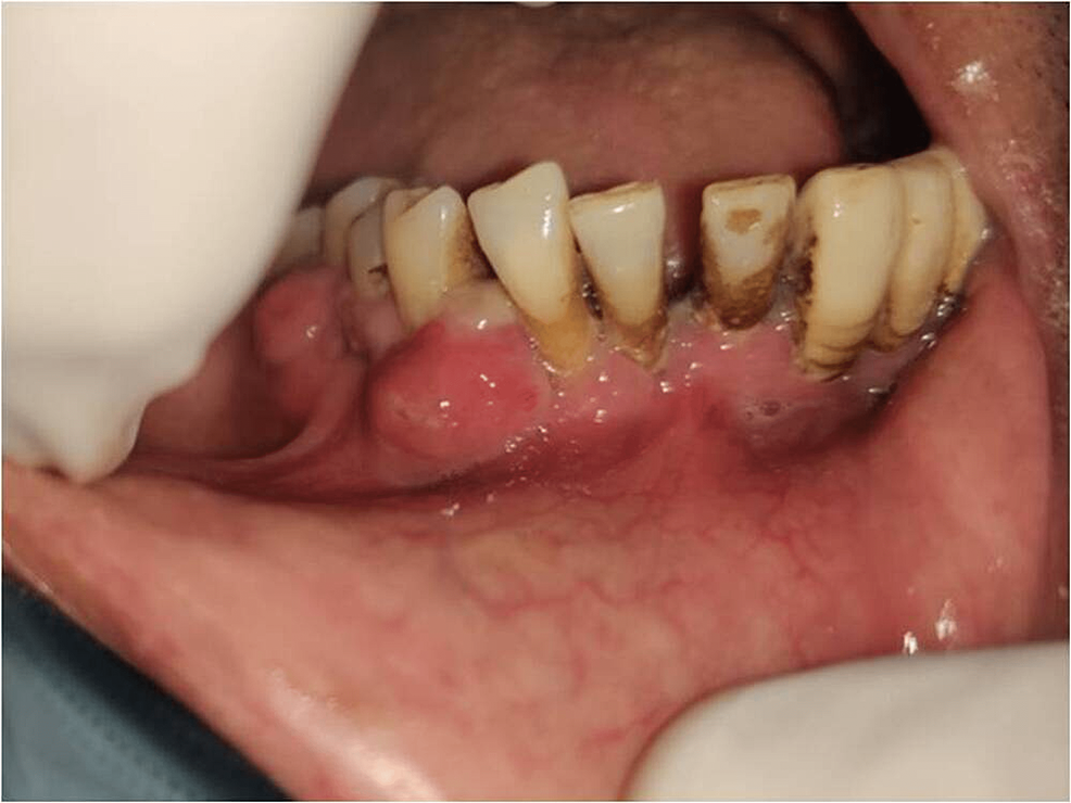 Intraoral-view-showing-gingival-swelling-of-right-side.