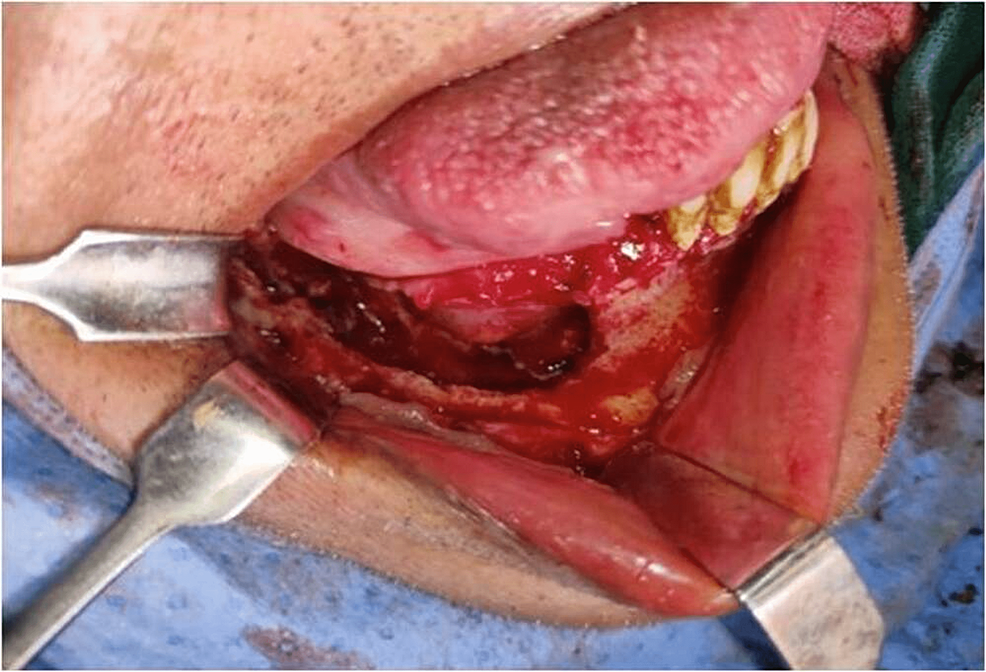 Intraoral-operative-procedure---surgical-debridement-of-right-mandible.