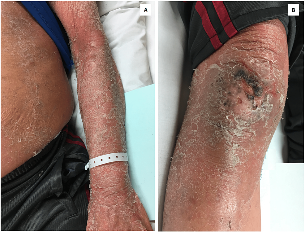 Severe-exfoliation-and-scaling-over-the-upper-limbs-(A)-and-lower-limbs-(B)